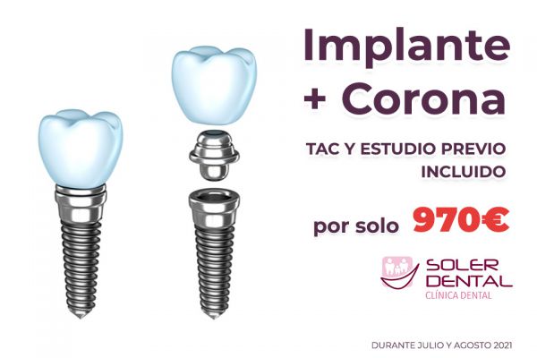 Implante Dental + Corona por solo 970€